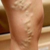 Варикозная болезнь ног, варикозная болезнь нижних конечностей